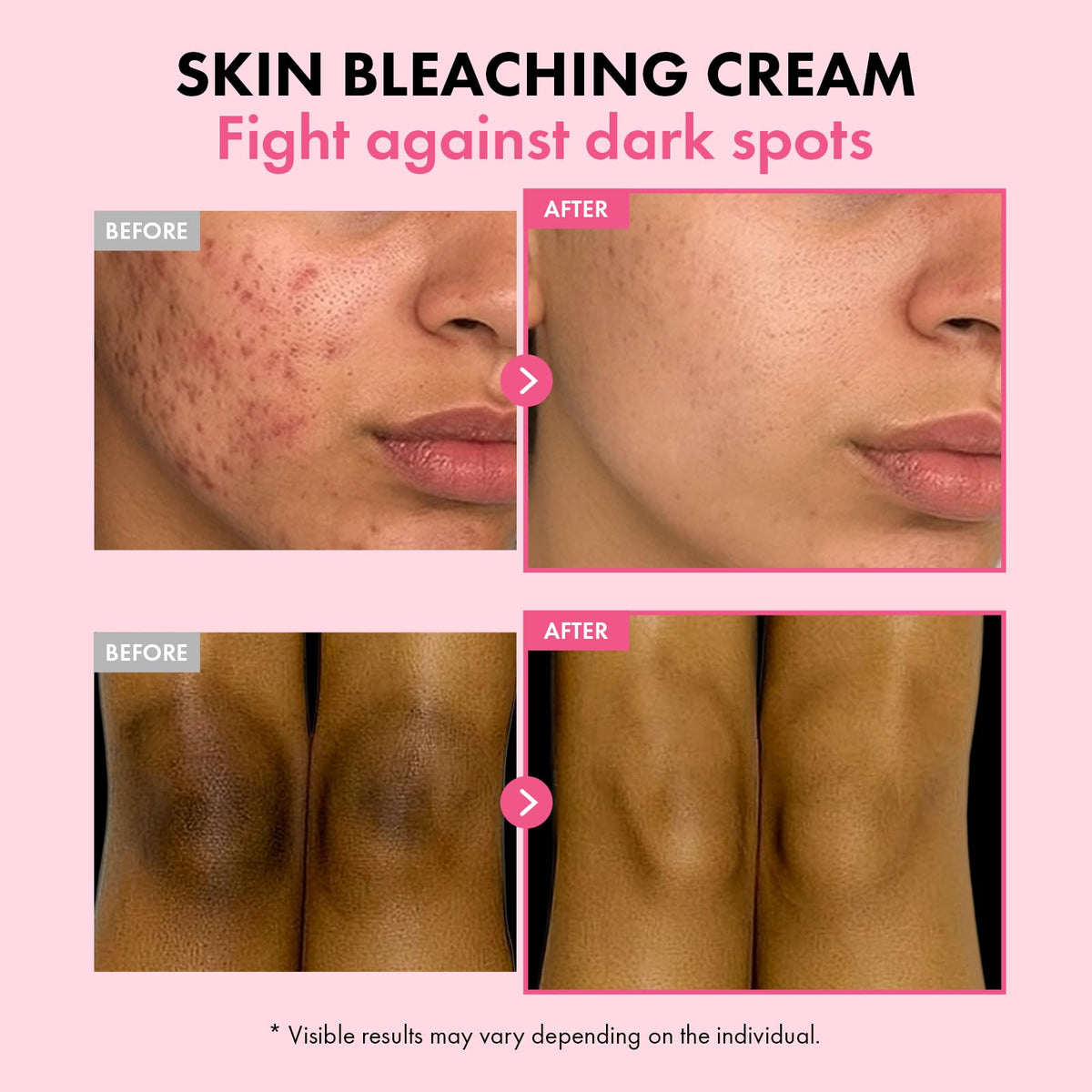 TOSOWOONG Dark Spot 35 Fade Cream for Dark Spots & Uneven Tone, Freckles