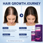 Minoxidil 5% Hair Regrowth Treatment for Women, 2-Month Supply | Topical Serum Drops for Thinning Hair, Revitalizes Hair Follicles, Reduces Hair Loss, Non-Greasy Liquid Formula