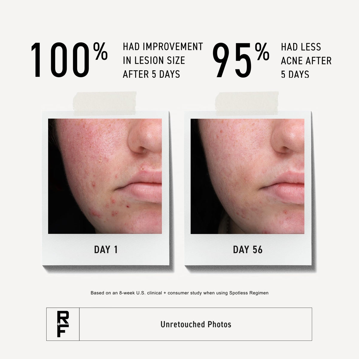 RODAN + FIELDS Spotless Daily Acne Wash | 125 mL | Morning & Night Skincare