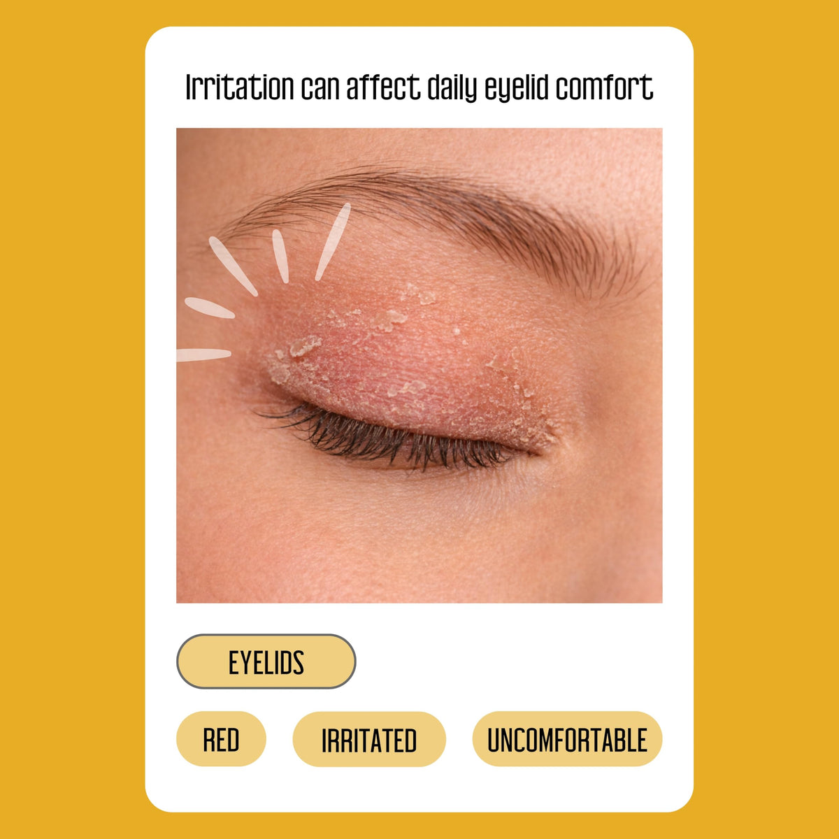 100 Pcs Manuka Oil Eyelid Wipes for Sensitive Lid Care & Eye Hygiene, Gentle Daily Eyelid Cleansing Wipes with Chamomile & Aloe Vera, Biodegradable, Free From Parabens & Sulfates