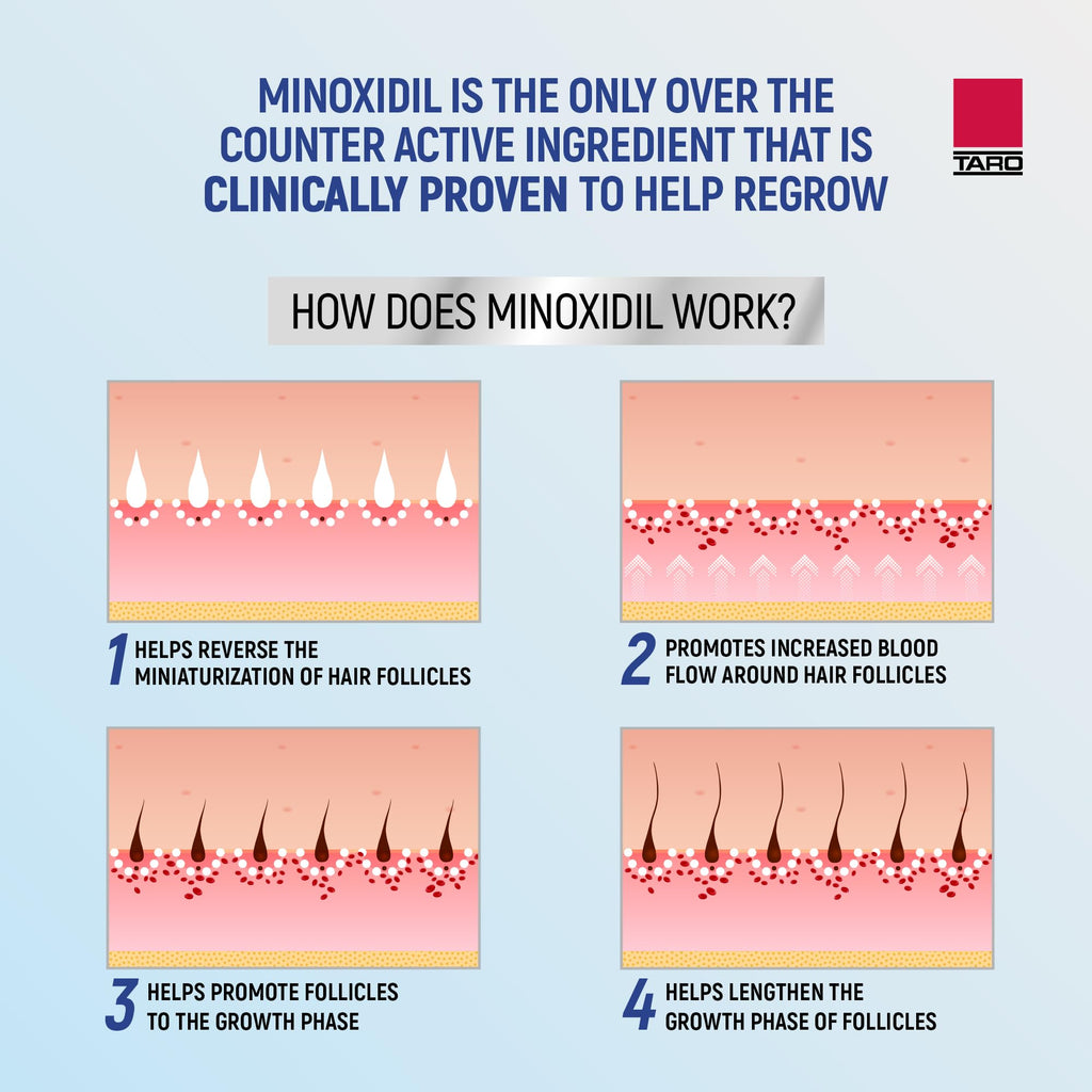 Minoxidil for Men, 2.11 Oz (1 Month Supply) Clinically Proven to Regrow Hair, Topical Aerosol Foam 5%, Hair Thinning Treatment