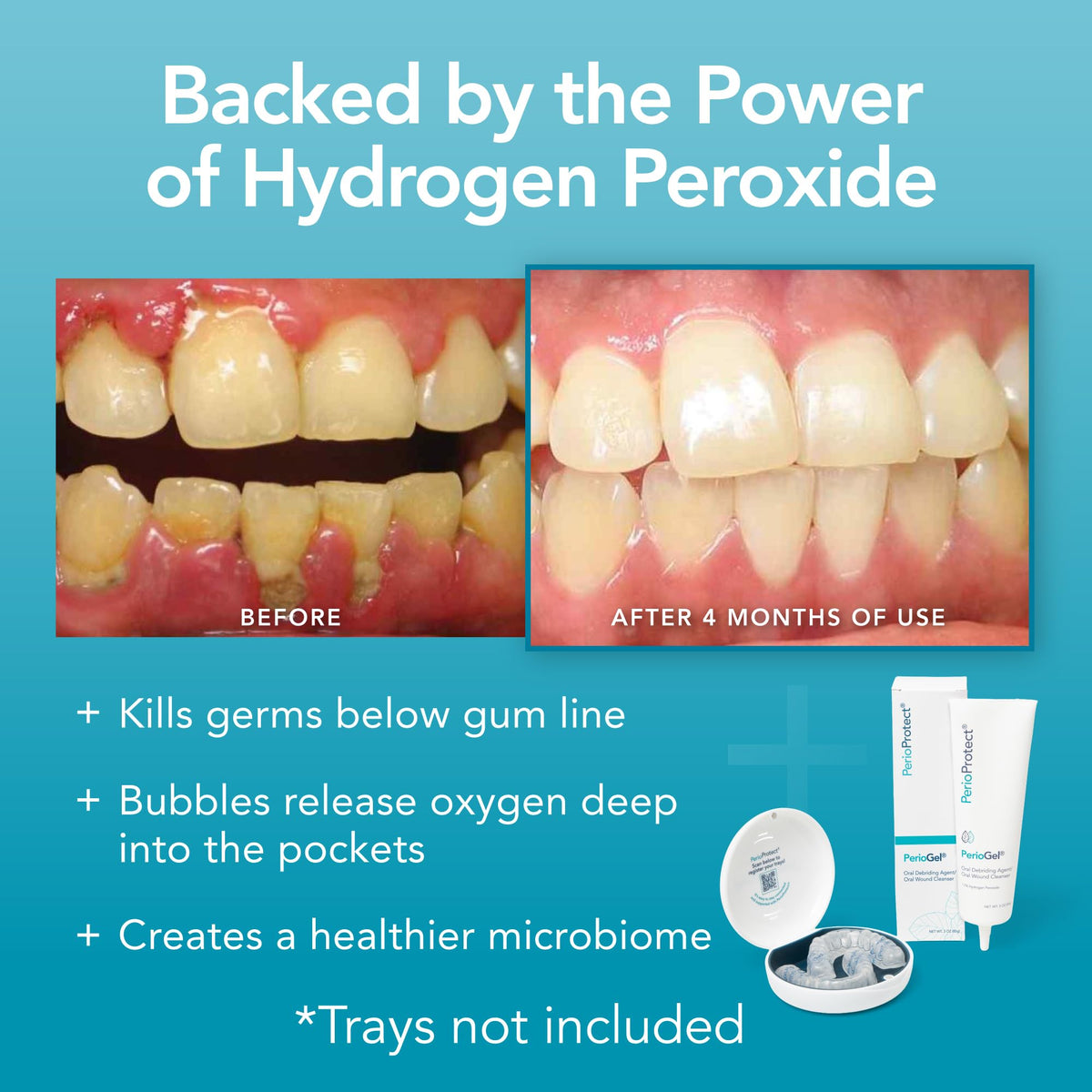 Perio Gel | Periodontal Treatment for Teeth | Promotes Teeth Whitening (3 oz.)