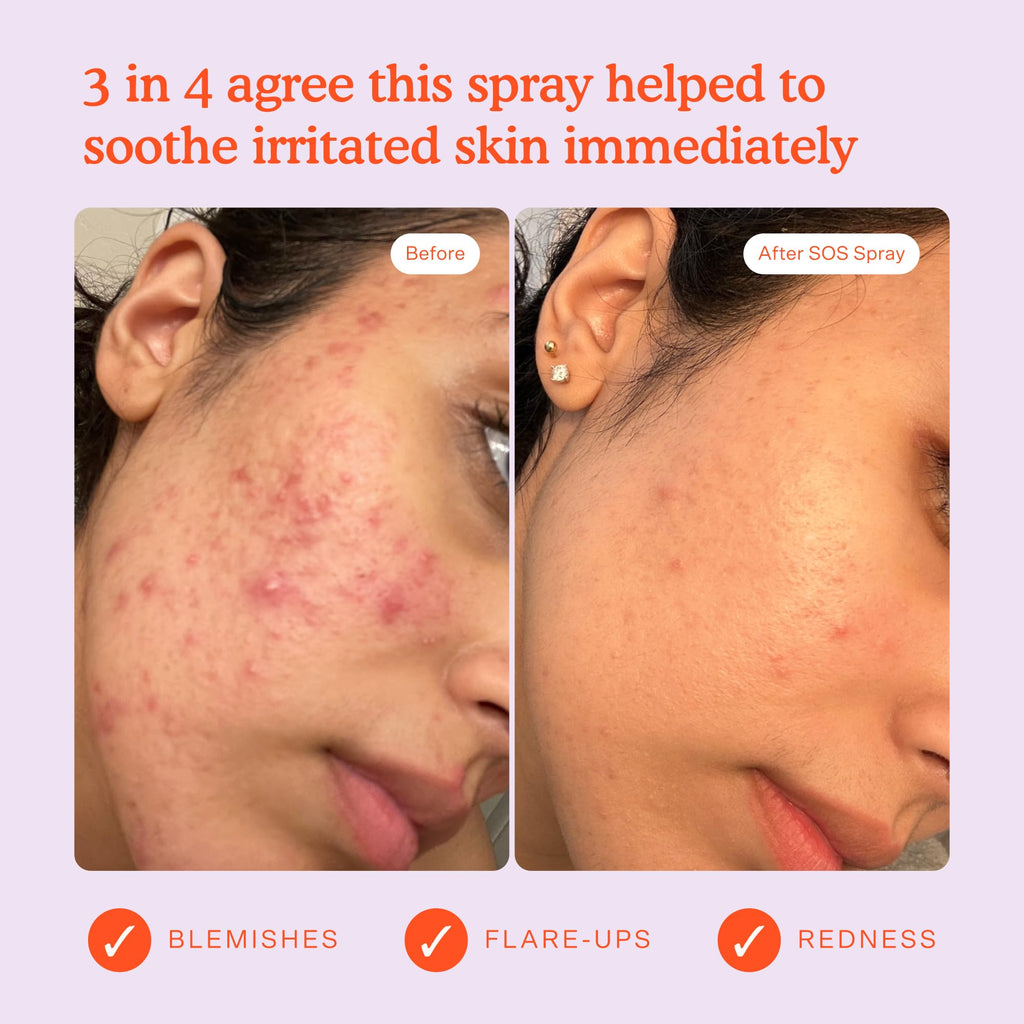 Buy now Tower 28 SOS Daily Rescue Facial Spray - Hypochlorous Acid Spray to Help Reduce Redness, Calm Irritation + Alleviate Flare-Ups - Purifying Travel Size Face Toner - Everyday Skin Care Essential (1 oz) at indiglob india