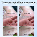 Mole & Wart Remover for Face & Body, Fast-Acting Freeze-Off