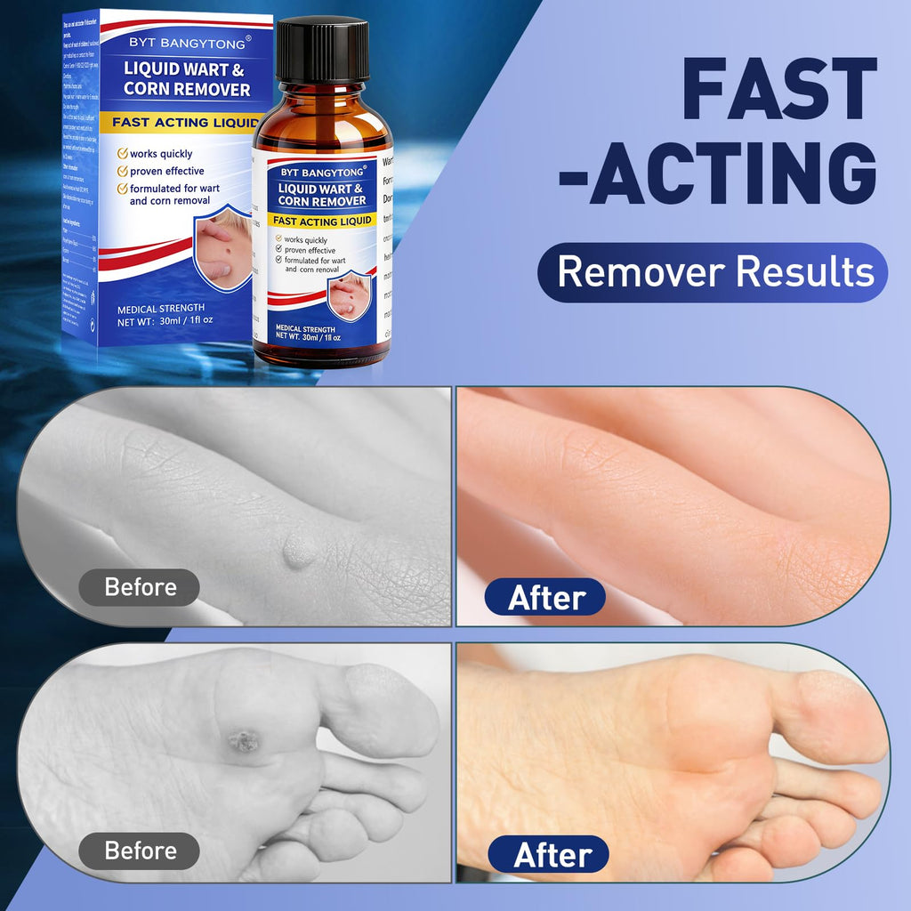 Wart Remover Liquid - Gentle Formula for Plantar Warts, Common & Corn on Feet, Hands and Other External Areas - Salicylic Acid - NET WT: 30ml/ 1fl oz