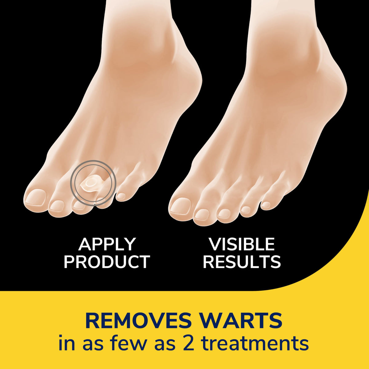 Dr. Scholl's One-Step Wart Remover Bandages, Removes Warts, 14 ct