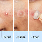 Invisible Pimple Patches for Face, Day & Night Acne Cover 330 Ct