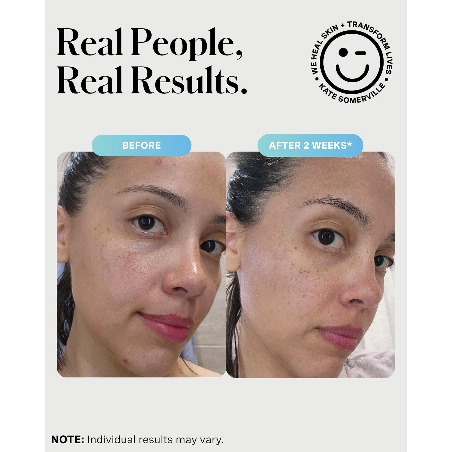 Kate Somerville EradiKate 3% Sulfur Daily Foaming Cleanser, 4 Fl Oz | Acne Treatment – Clinically Formulated Medicated Face Wash Balances Skin & Cleans Pores