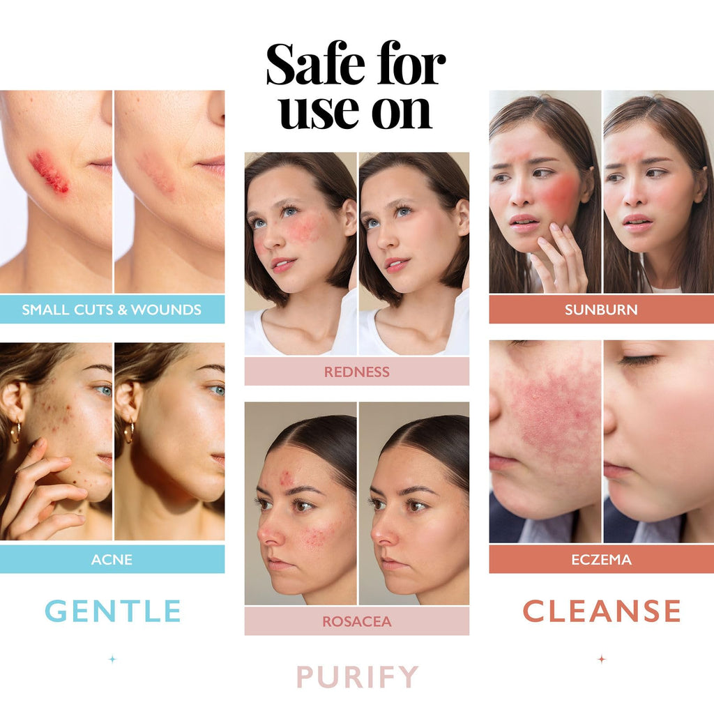 Hypochlorous Acid Spray for Face and Skin; Facial Cleanser | 8oz Face Mist | Antimicrobial Hypochlorous Acid Spray for Skin, Acne, Rash, Eczema, Wound | Topical Facial Cleanser Sprays; Smart Skincare