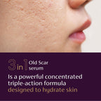 Mederma Scar Serum – Triple-Action Formula with Vitamin E, Hyaluronic Acid & Niacinamide – Clinically Shown to Reduce Old Scars, 1 Fl. Oz.