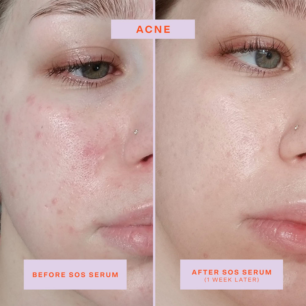 Buy now Tower 28 SOS Rescue Face Serum - Soothing Facial Serum with Hypochlorous Acid for Irritated, Sensitive Skin - Gently Helps Reduce Redness + Blemishes - Fragrance-Free Everyday Skin Care (2 oz) at indiglob india