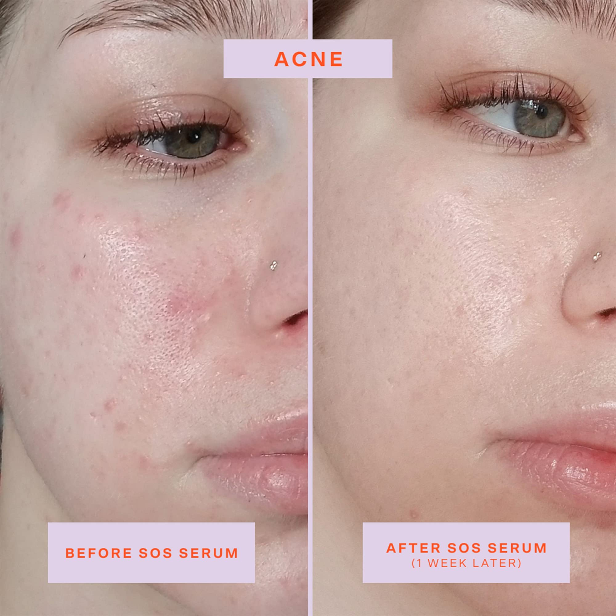 Buy now Tower 28 SOS Rescue Face Serum - Soothing Facial Serum with Hypochlorous Acid for Irritated, Sensitive Skin - Gently Helps Reduce Redness + Blemishes - Fragrance-Free Everyday Skin Care (2 oz) at indiglob india