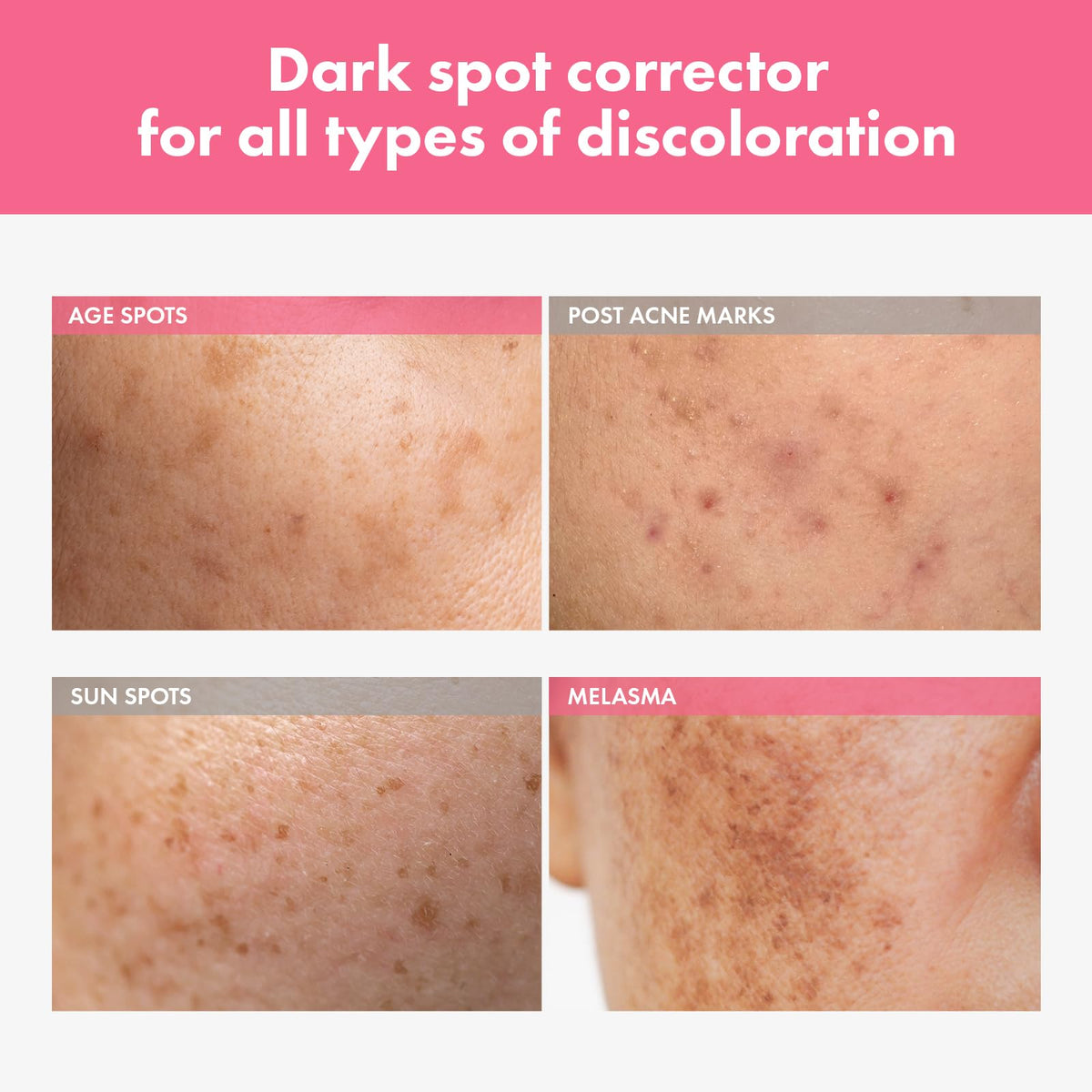 TOSOWOONG Arbutin 7% Intensive Spot Cream for Dark Spots, Freckles, Glow