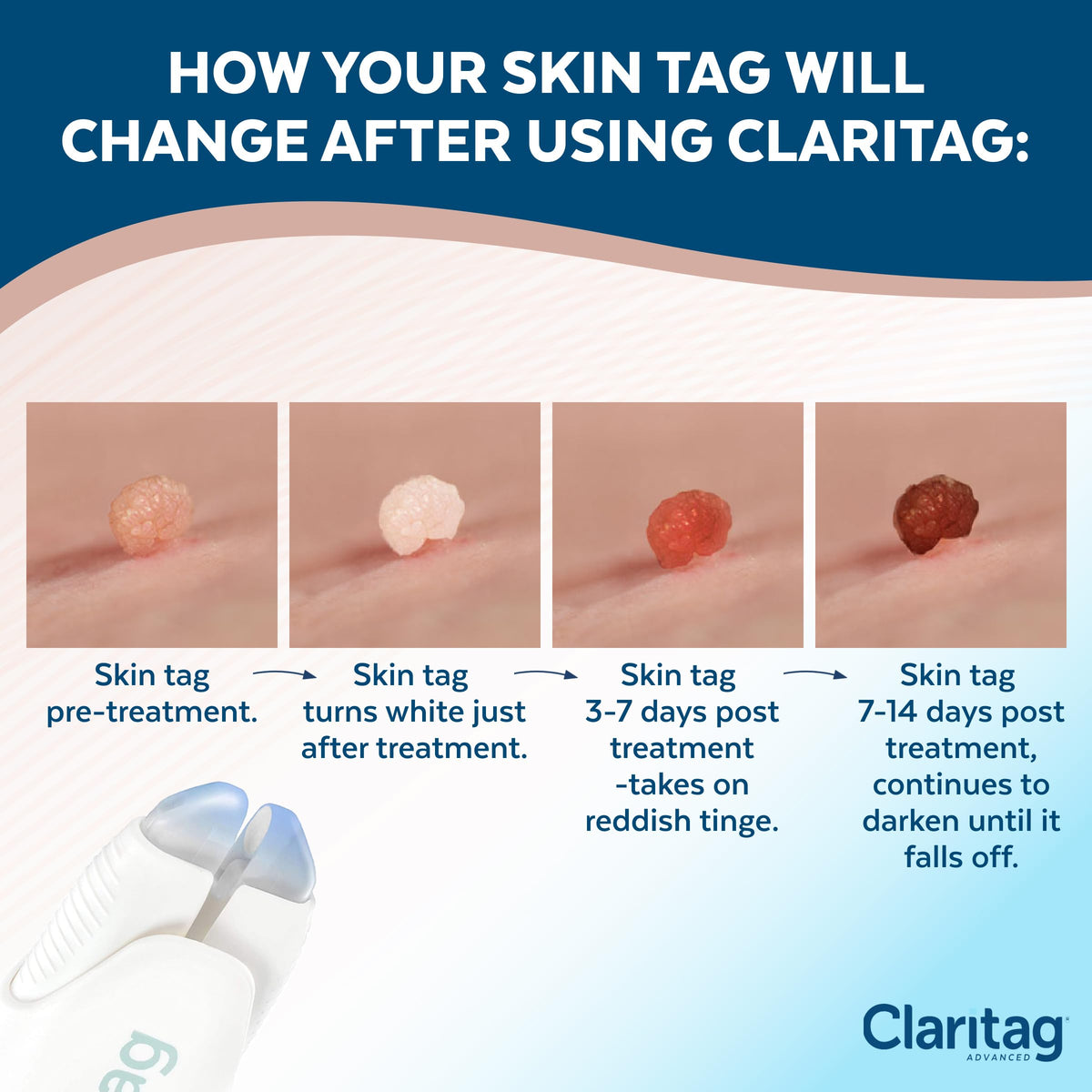 Claritag Advanced Skin Tag Remover, FDA-Cleared Freeze-Off Kit