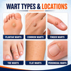 FLYLEAF 40% Salicylic Acid Wart Remover Liquid, Fast-Acting Maximum Strength Plantar Wart Remover for Common, Flat & Foot Warts, Corns & Calluses, Hands, Feet, Toes & Soles, 1.01 fl oz
