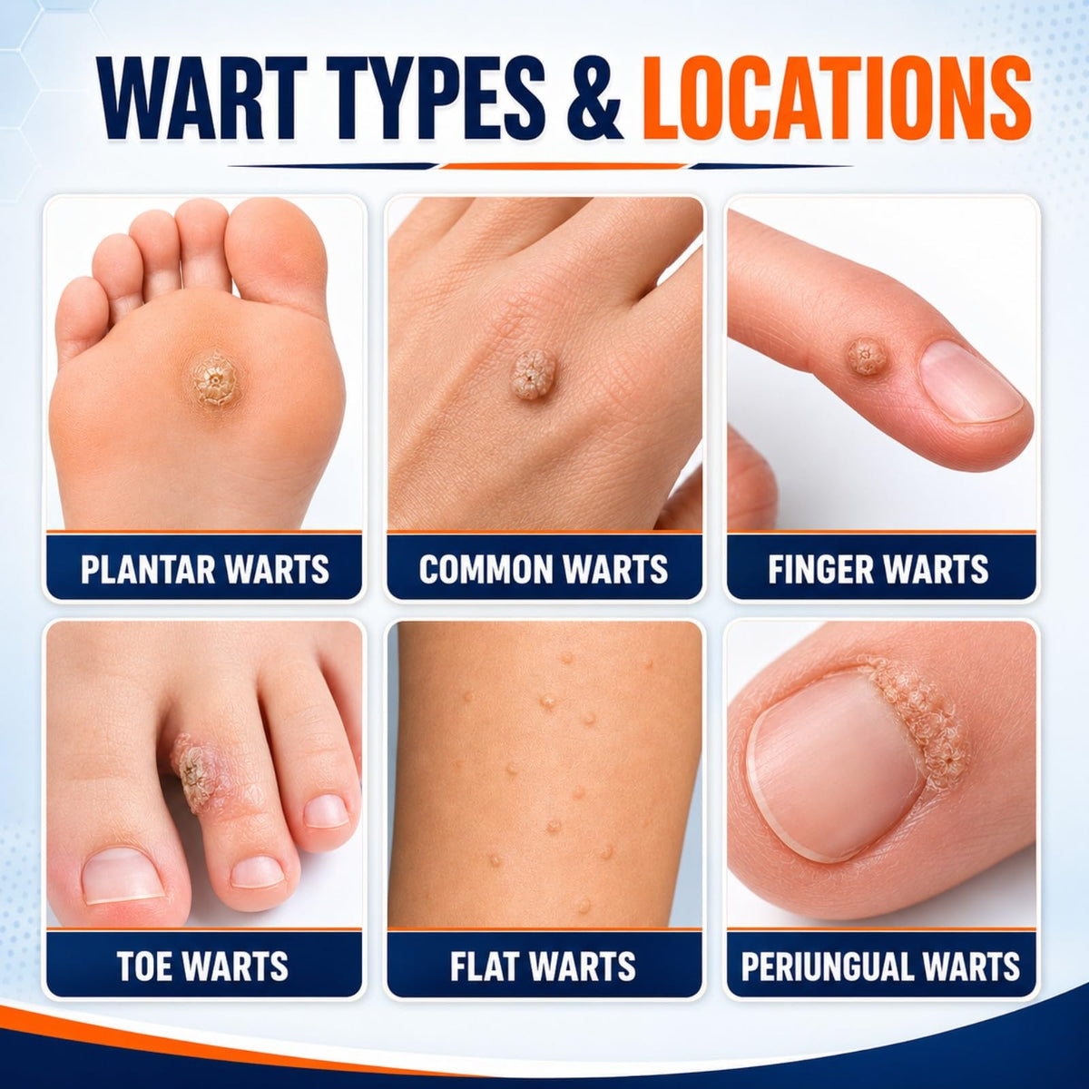 FLYLEAF 40% Salicylic Acid Wart Remover Liquid, Fast-Acting Maximum Strength Plantar Wart Remover for Common, Flat & Foot Warts, Corns & Calluses, Hands, Feet, Toes & Soles, 1.01 fl oz