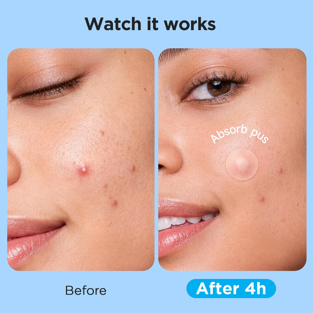 7 Sizes 831 Counts Pimple Patches Variety Pack for Face, Back | Hydrocolloid, Large Blemish Patches for Body, Chin, Chest, Cheek, Shoulder, Neck, Forehead (Dot, Moon, Rectangular, Square)