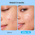 7 Sizes 831 Counts Pimple Patches Variety Pack for Face, Back | Hydrocolloid, Large Blemish Patches for Body, Chin, Chest, Cheek, Shoulder, Neck, Forehead (Dot, Moon, Rectangular, Square)