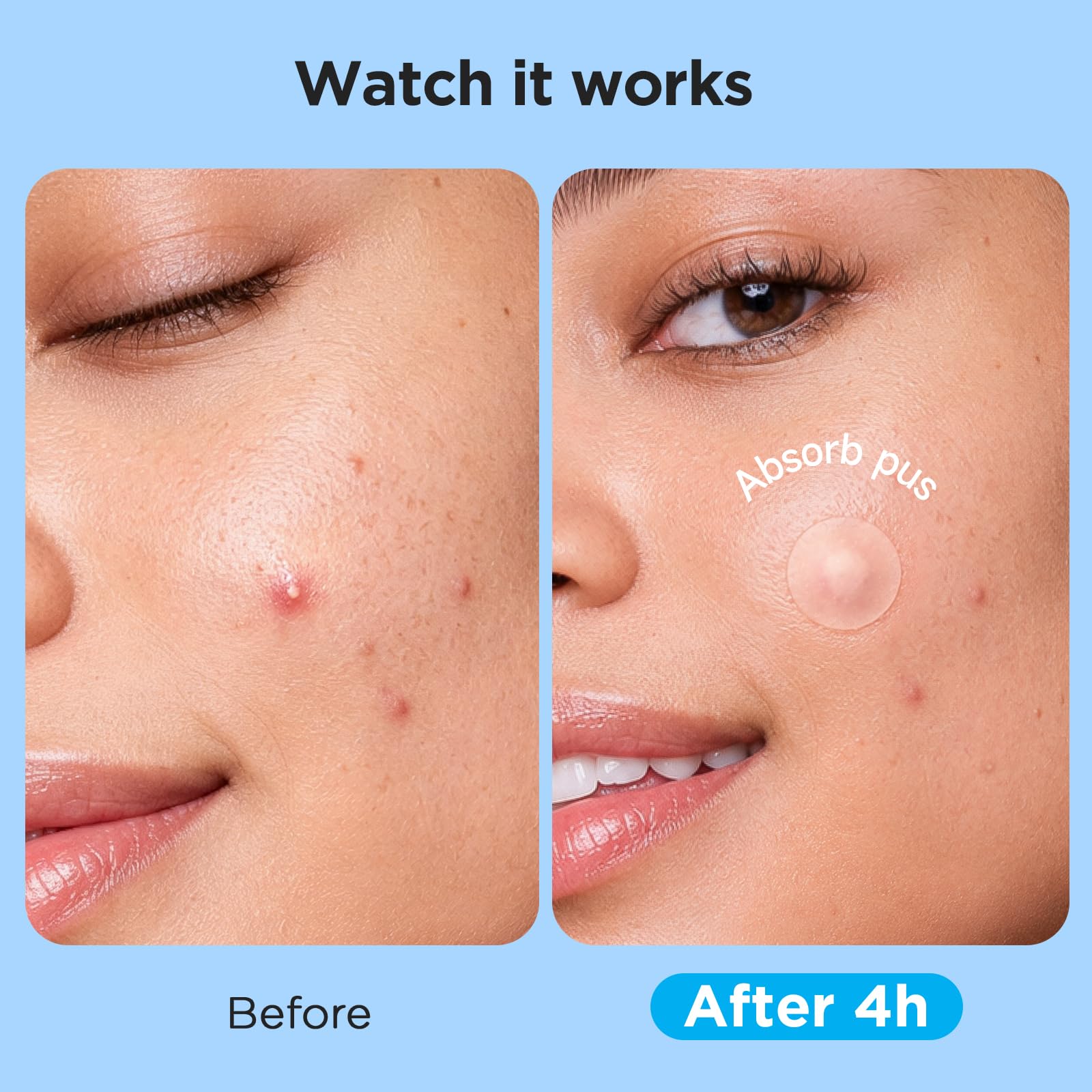 7 Sizes 831 Counts Pimple Patches Variety Pack for Face, Back | Hydrocolloid, Large Blemish Patches for Body, Chin, Chest, Cheek, Shoulder, Neck, Forehead (Dot, Moon, Rectangular, Square)