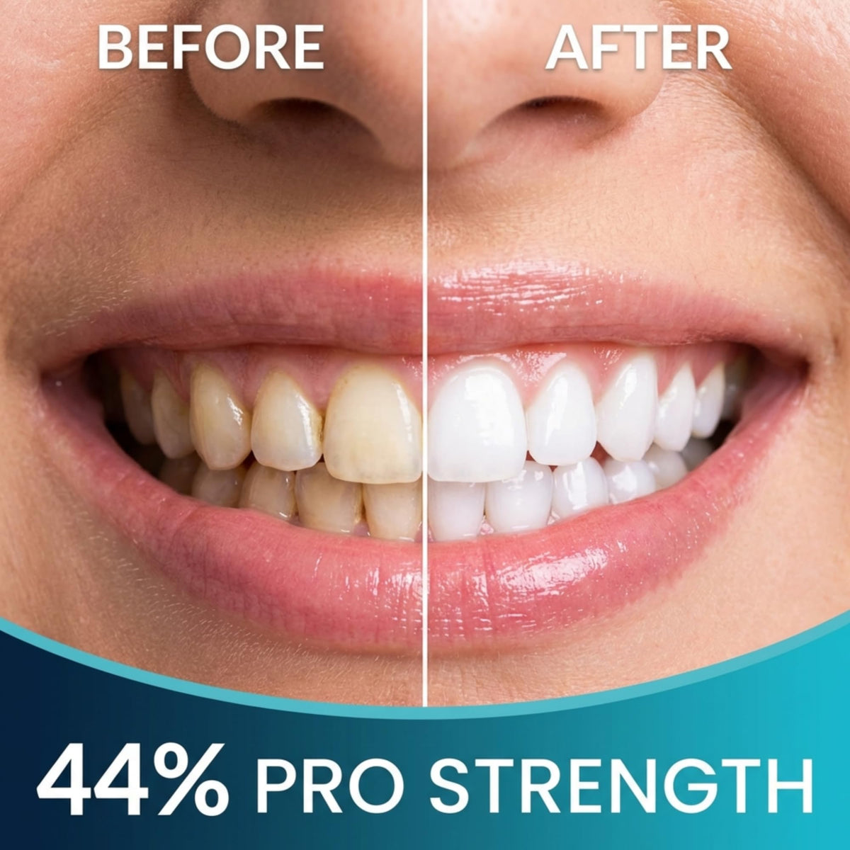 Teeth Whitening Gel with Trays 44% Carbamide Peroxide 5 Syringes - 50+ Uses