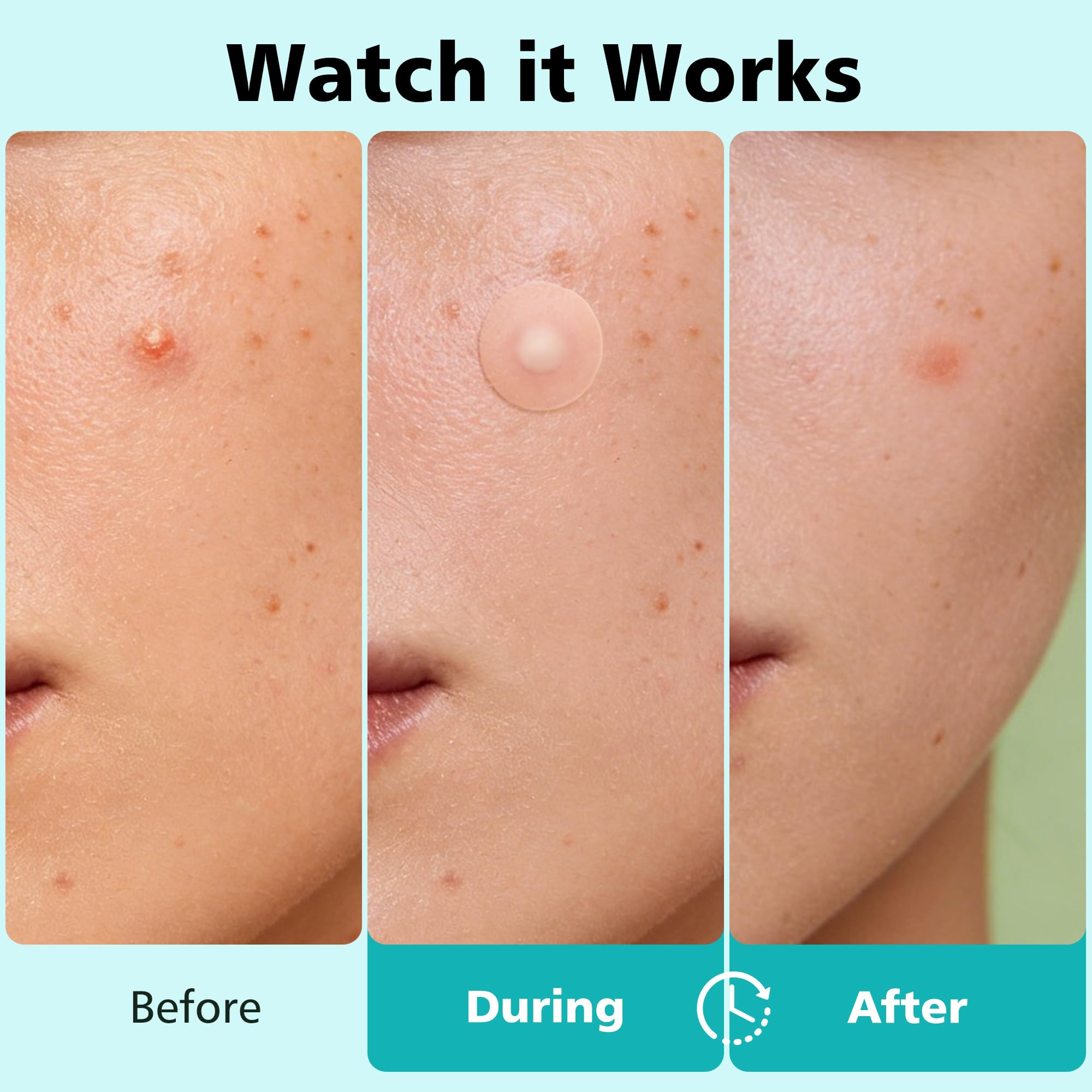 Pimple Patches for Face - 4 Size 600 Counts Acne Patches, Hydrocolloid Patches for Covering Zits and Blemishes, Spot Stickers with Salicylic Acid, Tea Tree Oil & Calendula Oil