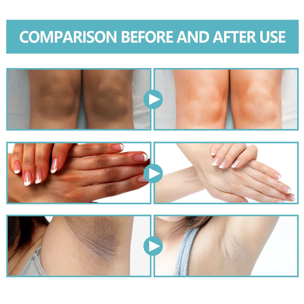 Acanthosis Nigricans Therapy Cream,Dark Spot Remover For Body,Dark Spot Corrector Cream,- Underarm, Neck, Armpit, Knees, Elbows, Private Areas, Intimate Areas - Upgraded Formula, - 2.1Fl Oz