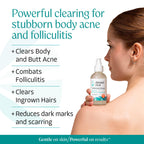 Almond Clear Mandelic Acid Level 2 Serum – Extra Strength Treatment for Body Acne, Folliculitis, and Ingrown Hairs – Buttocks Clearing Dark Spot Remover – 1 Fl Oz
