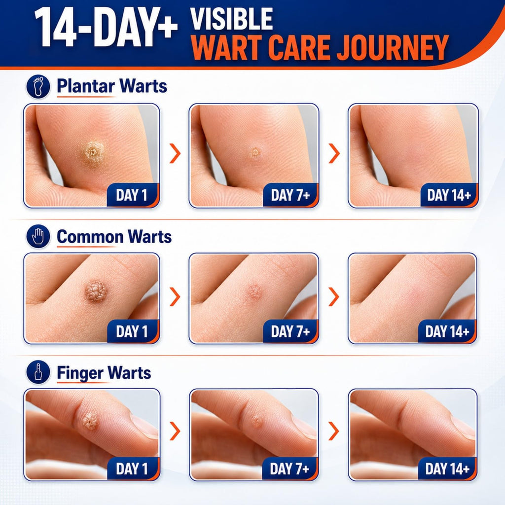 FLYLEAF 40% Salicylic Acid Wart Remover Liquid, Fast-Acting Maximum Strength Plantar Wart Remover for Common, Flat & Foot Warts, Corns & Calluses, Hands, Feet, Toes & Soles, 1.01 fl oz