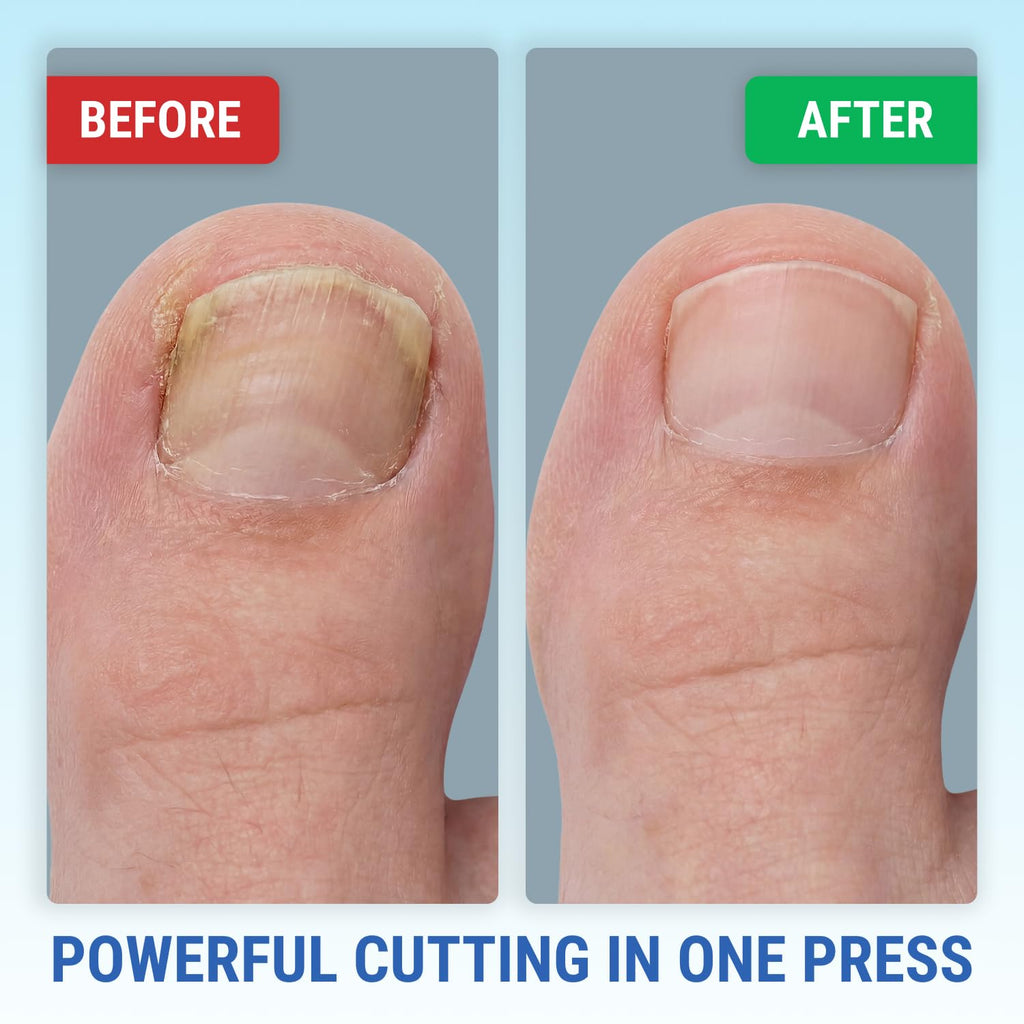 Toenail Clippers for Thick Toenails – KLIPP 15 mm Wide Jaw Thick Fingernail and Toenail Cutter with Curved Stainless-Steel Blades for Seniors (Eagle Beak)
