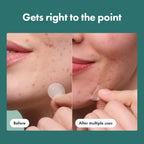 Mighty Patch Hero Cosmetics Micropoint Acne Pimple Patches, 8 Ct | For Early Stage Zits & Hidden Blemishes; Hydrocolloid with Salicylic Acid, Niacinamide, Cica; 395 Micropoints; Acne Stickers