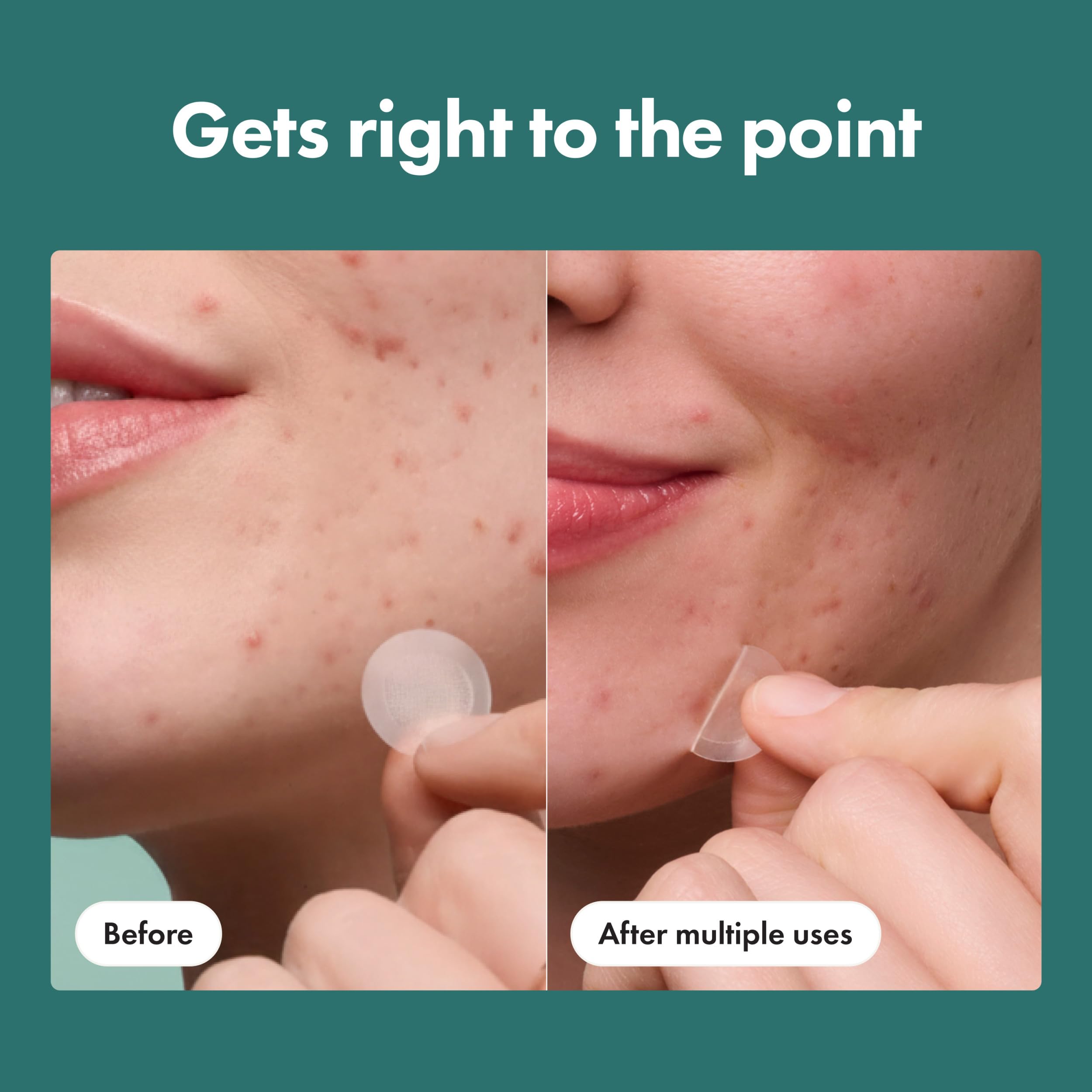 Mighty Patch Hero Cosmetics Micropoint Acne Pimple Patches, 8 Ct | For Early Stage Zits & Hidden Blemishes; Hydrocolloid with Salicylic Acid, Niacinamide, Cica; 395 Micropoints; Acne Stickers