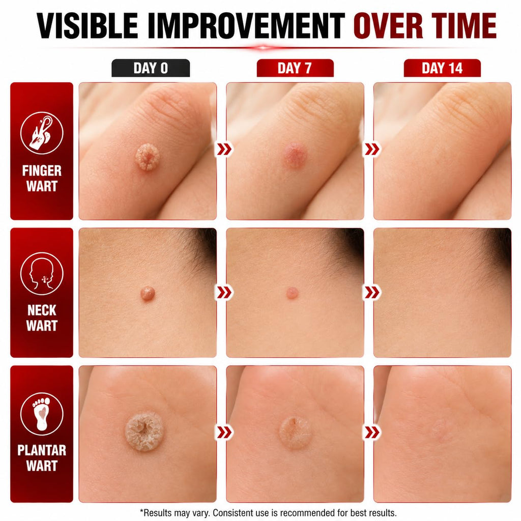 40% Salicylic Acid Wart Remover for Plantar Warts and All Types Wart