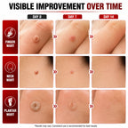 40% Salicylic Acid Wart Remover for Plantar Warts and All Types Wart