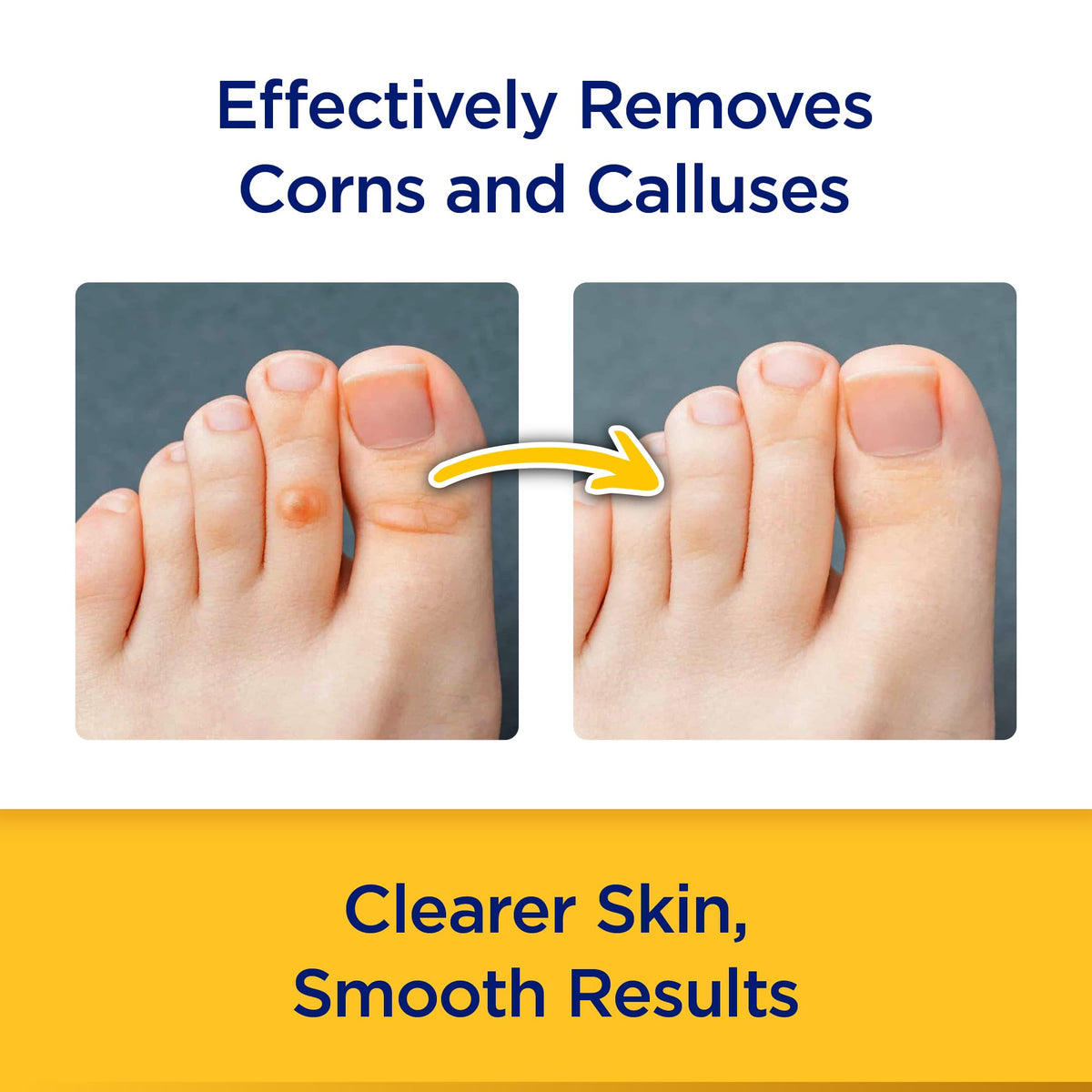 CornStick Corn and Callus Remover, 0.2 Oz
