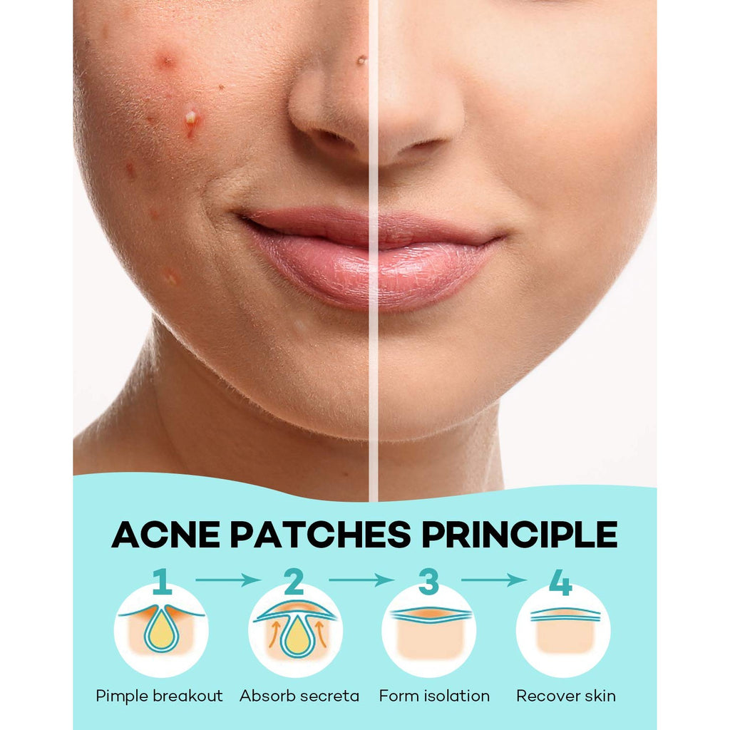 TKTK Pimple Patch for Face, Hydrocolloid Acne Absorbing Dots, 4 Sizes 140CT | Invisible Acne Patches Zit Stickers with Tea Tree & Calendula Oil, for Blemishes & Breakouts,Safe for Sensitive Skin