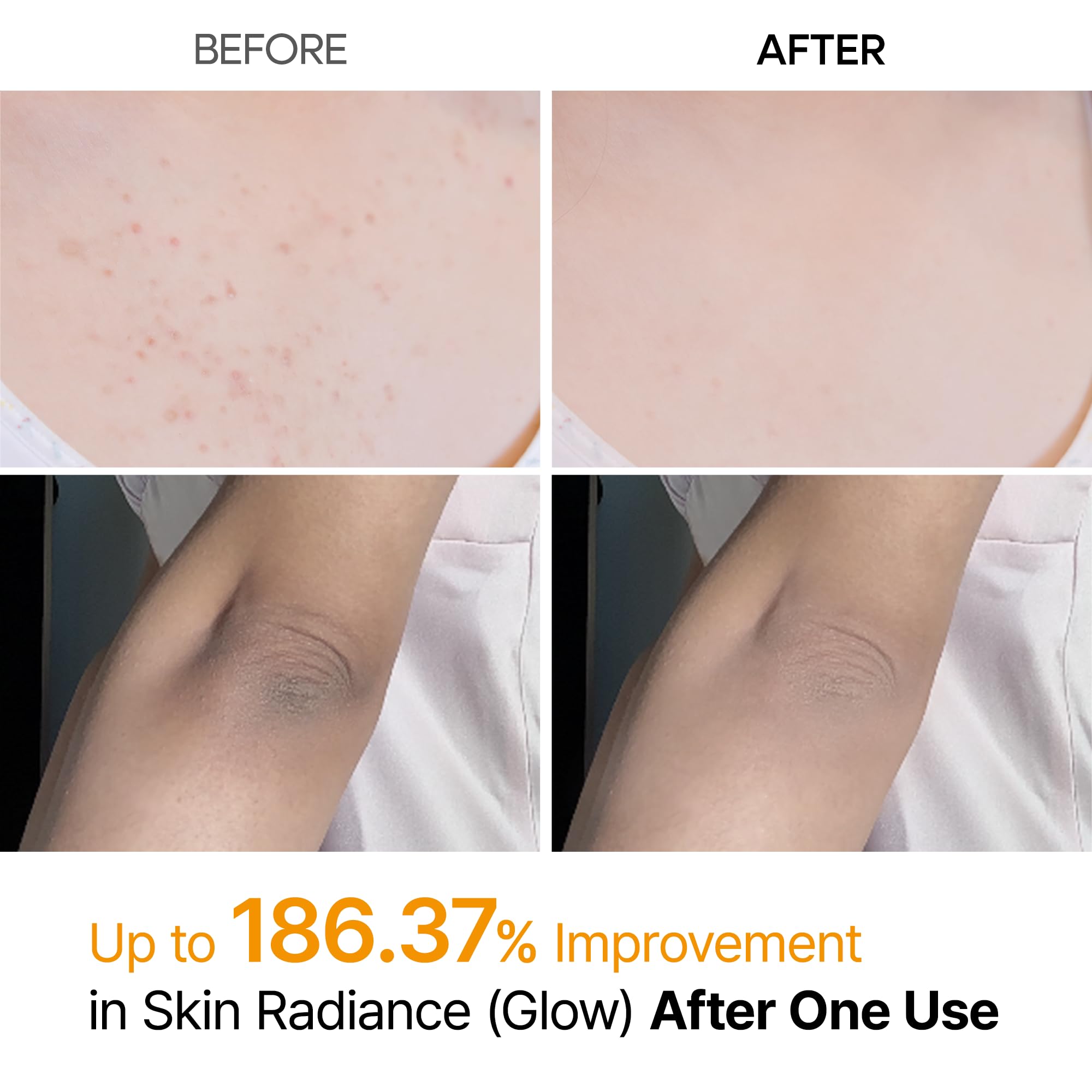 Dr.Melaxin Peel Shot Kojic Acid Turmeric Body Exfoliator Spray 6.76 fl.oz - AHA PHA Niacinamide Body Scrub for KP Bumps, Dark Spots, Uneven Skin Tone, Dead Skin, Korean Skin Care