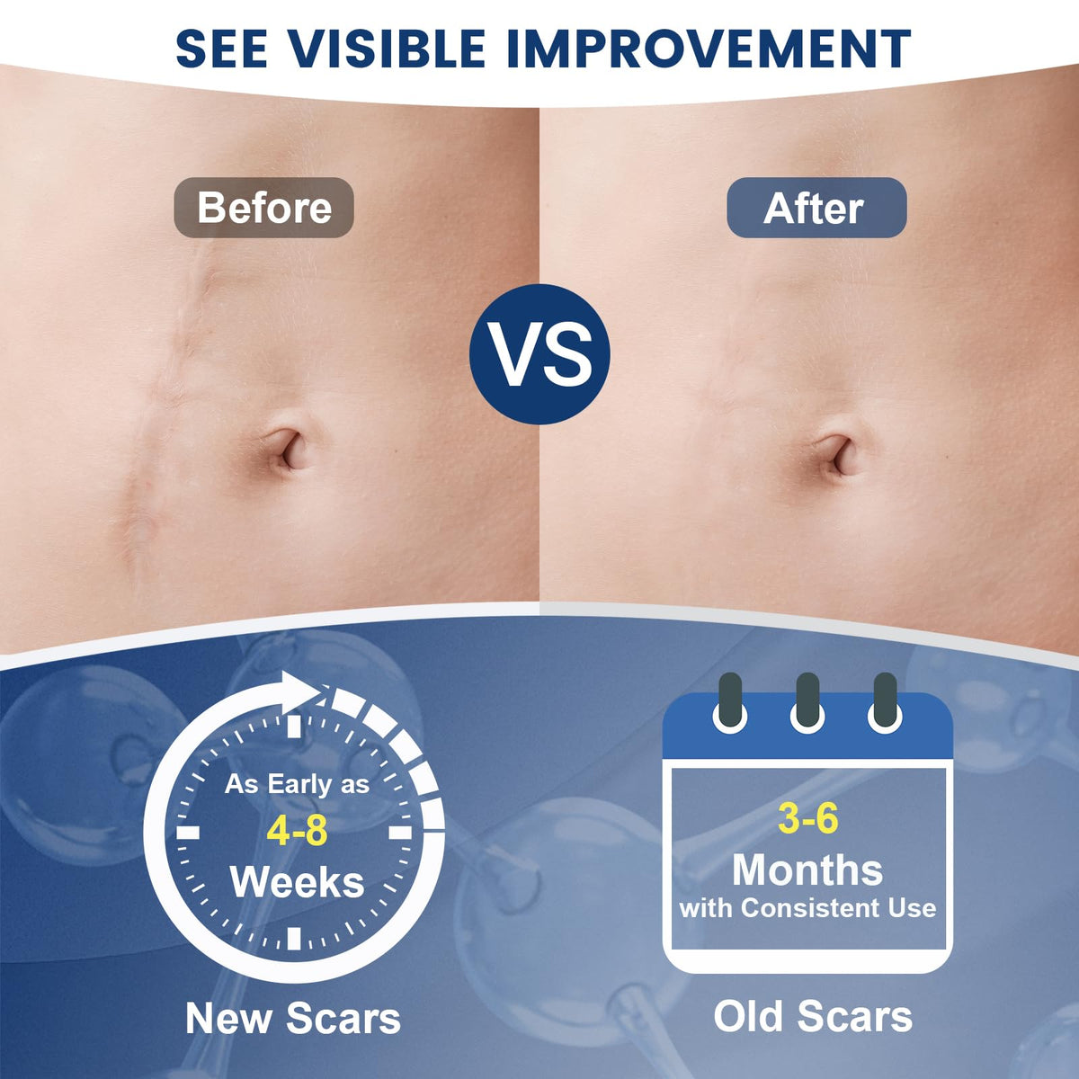 Rvlaim 100% Advanced Silicone Scar Gel for Old & New Scars,1.7oz/50ml