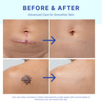 Suquato Silicone Scar Stick – Silicone Keloid Scar Removal Cream for Face & Body, Helps Improve Surgical Scars, C-Section, Acne Scars & Stretch Marks, Portable Twist Stick– 20g