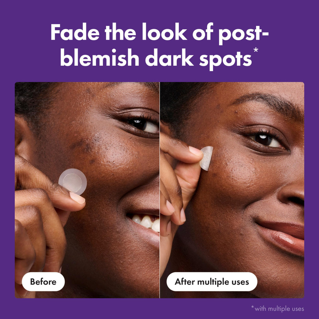 Mighty Patch Hero Cosmetics for Dark Spots Post-Blemish Patch, 8 Ct | Acne Patch with 395 Micropoints, Formulated With Vitamin C, Niacinamide; Dermatologist Tested; Non-Irritating