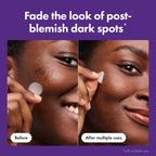 Mighty Patch Hero Cosmetics for Dark Spots Post-Blemish Patch, 8 Ct | Acne Patch with 395 Micropoints, Formulated With Vitamin C, Niacinamide; Dermatologist Tested; Non-Irritating