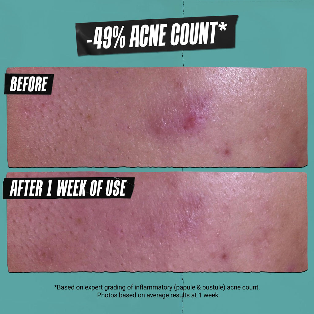 Buy now Kiehlâ€™s Acne-Treating Cleansing Paste, with Salicylic Acid, Multi-Use Product for Cleanser, Spot Treatment, and Face Mask, Non-Drying for All Skin Types, 4.2 Fl. Oz at indiglob india