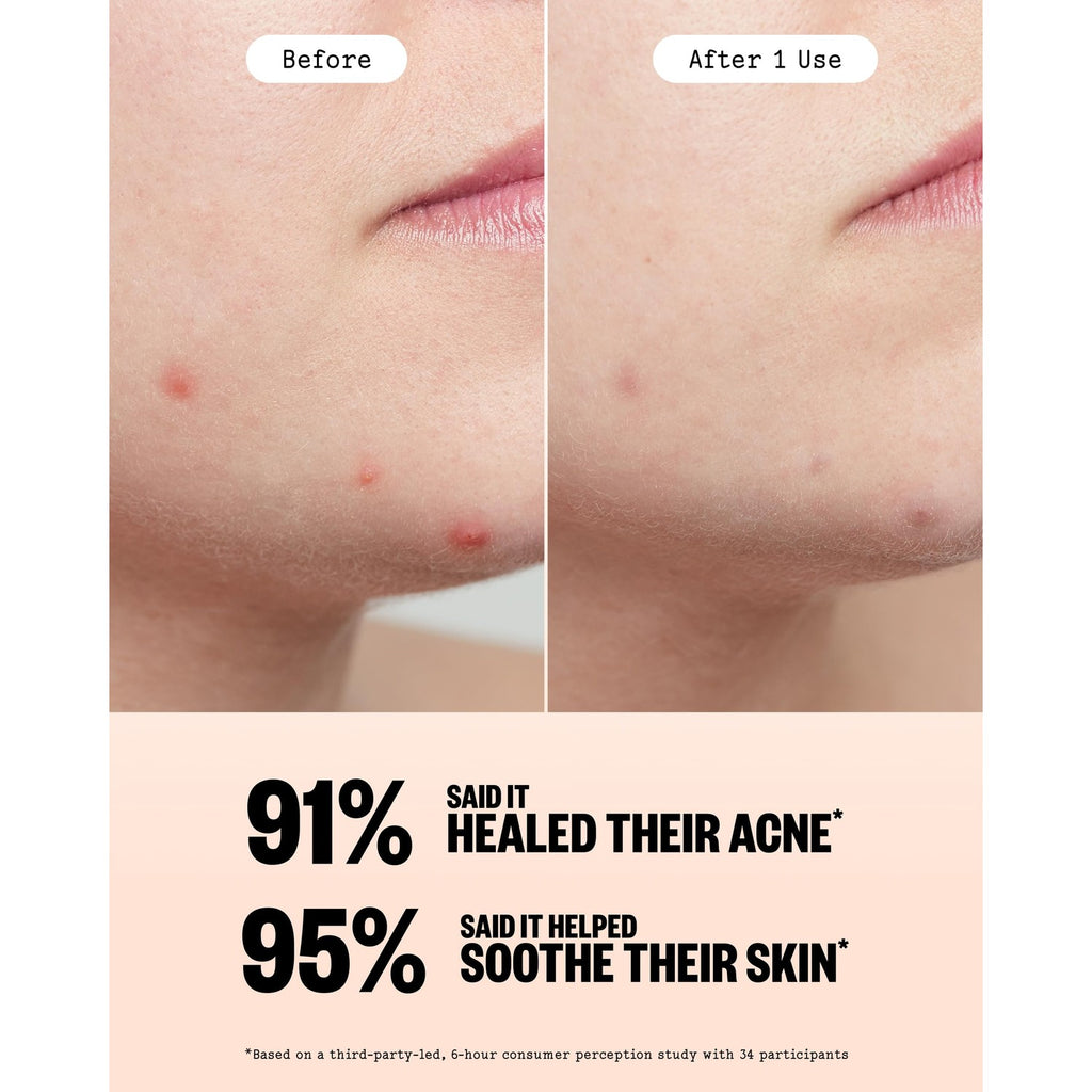 PEACE OUT Acne Healing Dots Hydrocolloid Pimple Patches (60 count) | Fast Acting Acne Spot Treatment for Blemishes & Breakouts with Salicylic Acid, Retinol and Aloe Vera, Award Winning Skincare
