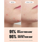 PEACE OUT Acne Healing Dots Hydrocolloid Pimple Patches (60 count) | Fast Acting Acne Spot Treatment for Blemishes & Breakouts with Salicylic Acid, Retinol and Aloe Vera, Award Winning Skincare