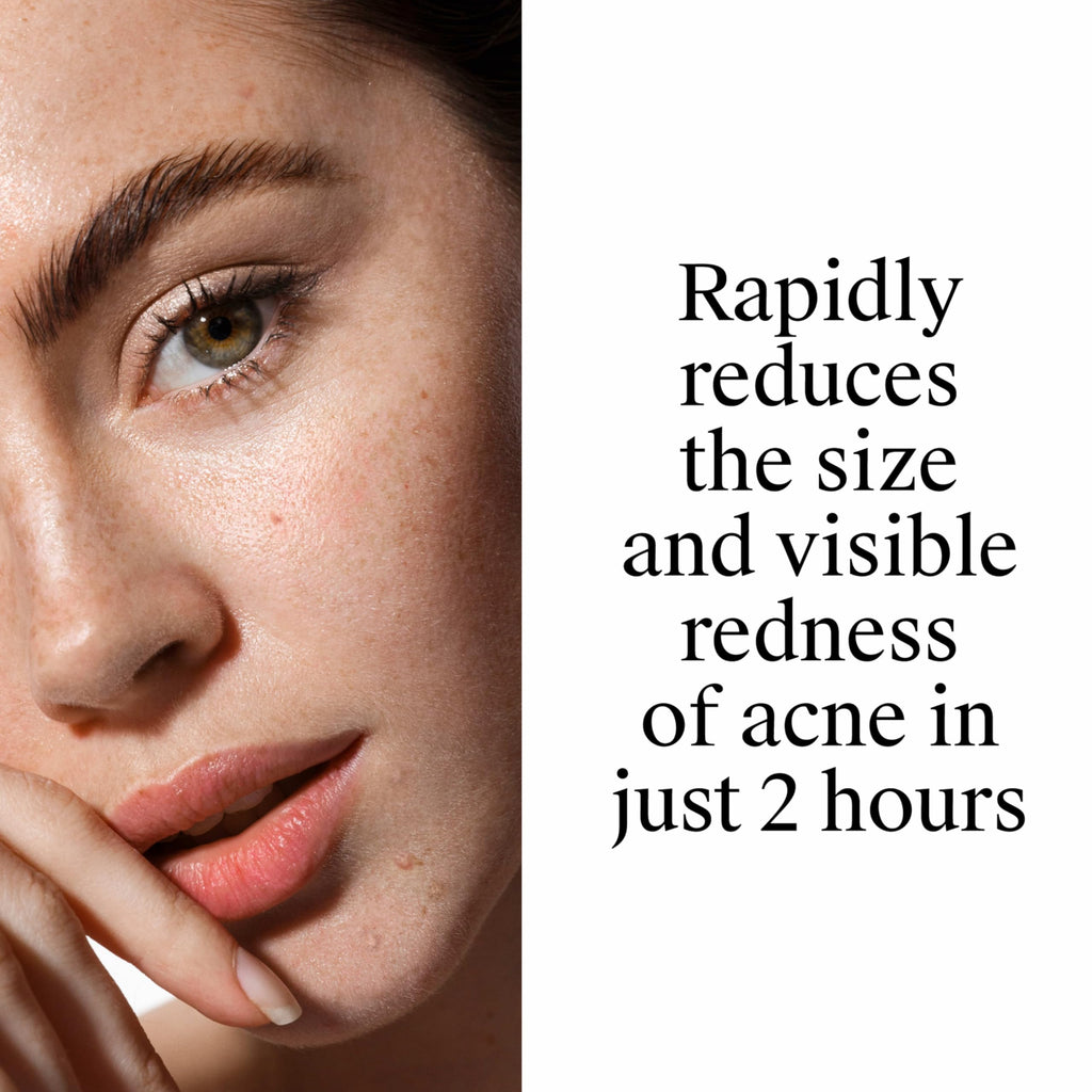 Neutrogena Rapid Clear Stubborn Acne Spot Treatment Gel, 1 oz