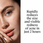 Neutrogena Rapid Clear Stubborn Acne Spot Treatment Gel, 1 oz