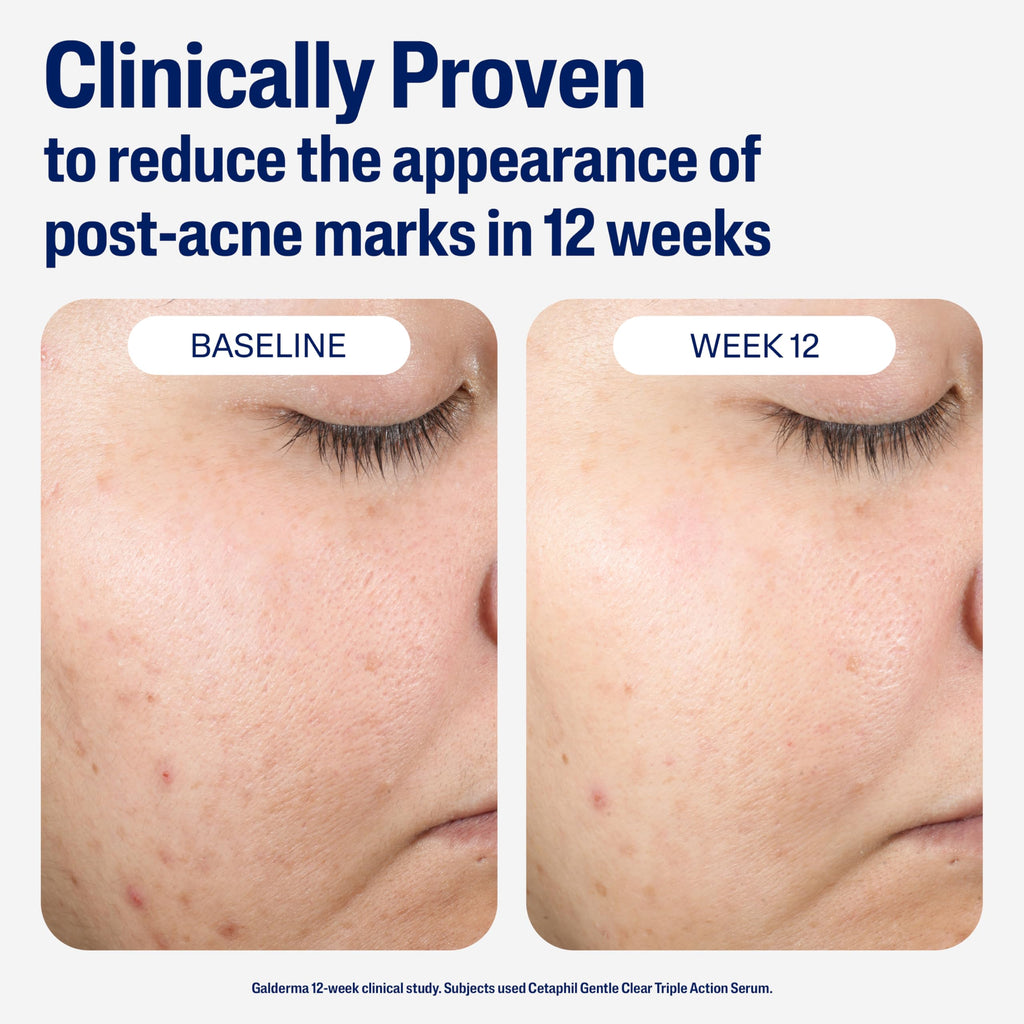 Buy now CETAPHIL Gentle Clear Repairing Post-Acne Serum, Retinol Alternative, Oil Free Serum for Sensitive Skin, 1 Fl Oz, Bakuchiol, Improves Skin Tone & Post-acne Marks, Dermatologist Recommended Brand at indiglob india