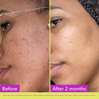 Good Molecules 10% Azelaic Acid Treatment for Face – Blurs Facial Redness & Evens Skin Tone – Brightens the Look of Dark Spots & Refines Texture – Vegan & Fragrance-Free Skincare (30ml / 1.01 fl oz.)