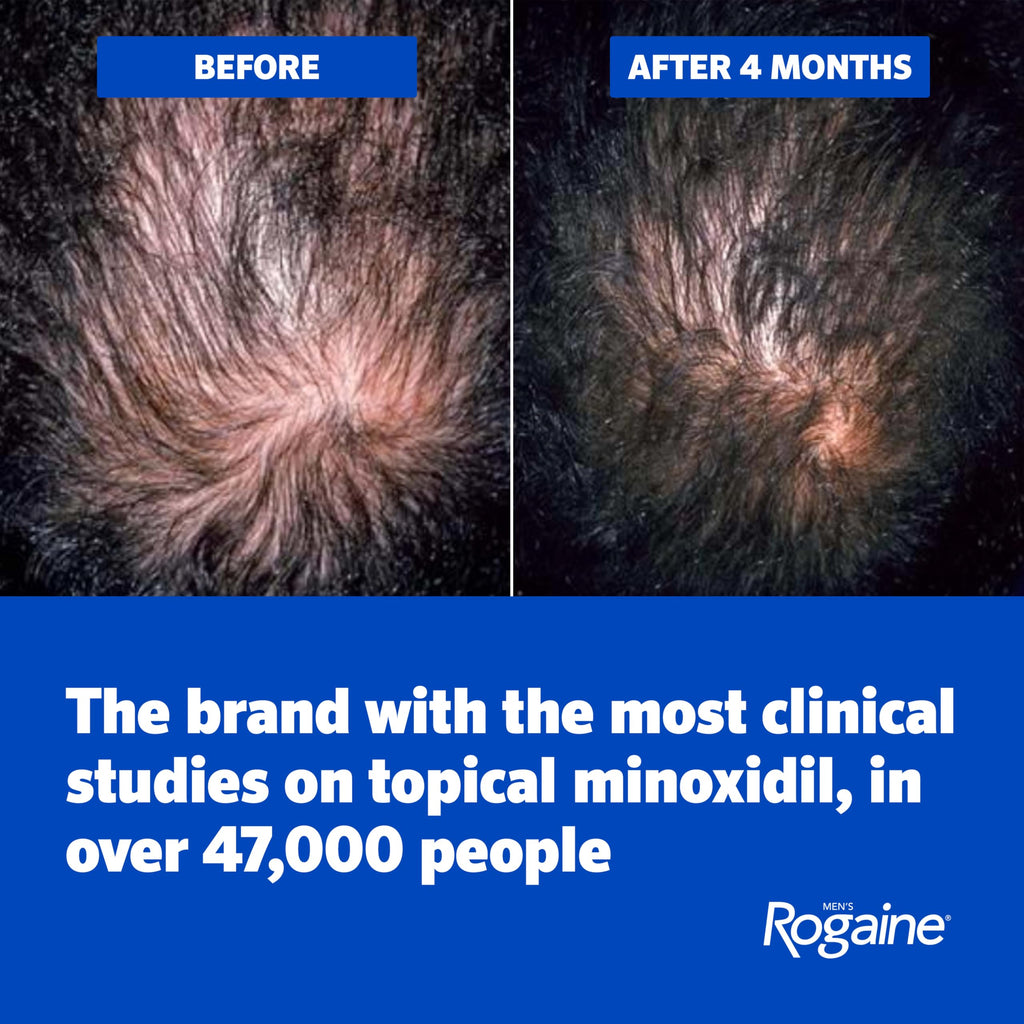 Men's Rogaine 5% Minoxidil Topical Foam, Unscented, 3 Mo Supply, 3x 2.11 Oz | Hair Regrowth Foam, Topical Hair Loss Treatment for Men, Regrow Fuller, Thicker Hair, Unscented, Aerosol, 3-Month Supply