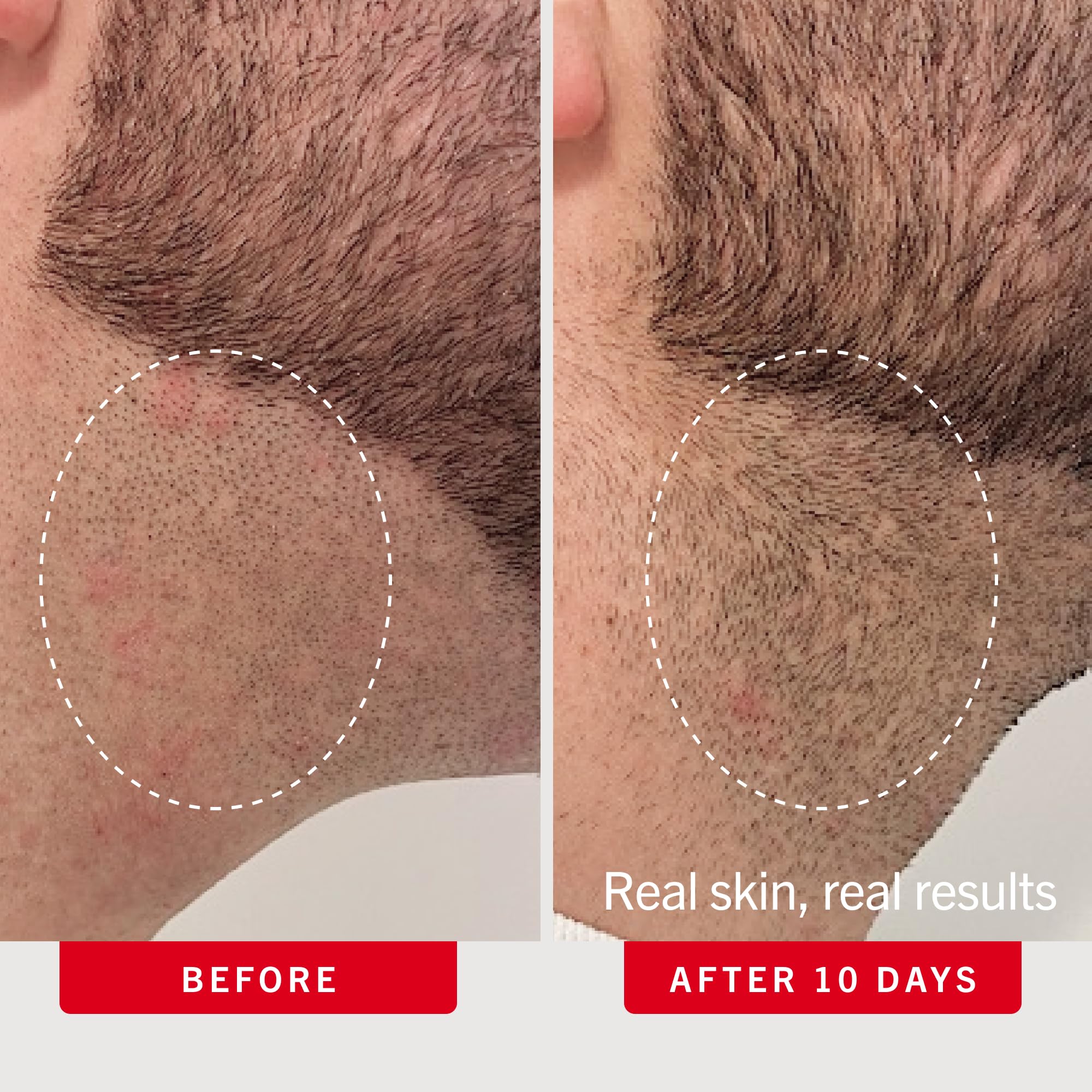 First Aid Beauty Ingrown Hair Pads Aftershave Treatment to Help Prevent Razor Bumps, Exfoliate Underarms & Bikini Area, Sensitive Skin