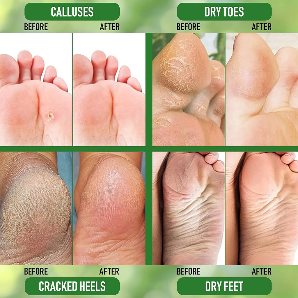 Buy now Urea 20% Healing Cream 4 oz - Best Callus Remover - Moisturizes and Rehydrates Hands, Feet and Knees to a Healthy Appearance - Soothes and Softens Thick, Cracked, Rough Dead and Dry Skin at indiglob india